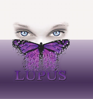 Systemic Lupus Erythematosus