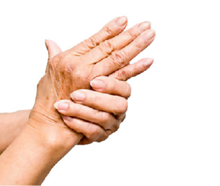 Rheumatoid Arthritis  