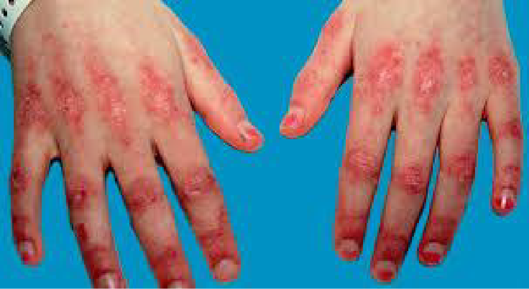 Inflammatory Myositis